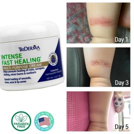 TriDerma Intense Fast Healing Cream, Decreases Healing Time for Minor Irritations, Rashes, Scrapes, Cuts 4 Ounces TriDerma Intense Fast Healing Cream, Decreases Healing Time for Minor Irritations, Rashes, Scrapes, Cuts 4 Ounces