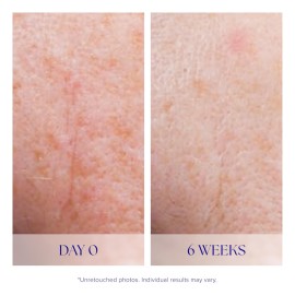 iS CLINICAL Active Serum; Face Serum, Anti-Aging, Helps skin with acne and pigmentation, 0.5 Fl Oz iS CLINICAL Active Serum; Face Serum, Anti-Aging, Helps skin with acne and pigmentation, 0.5 Fl Oz