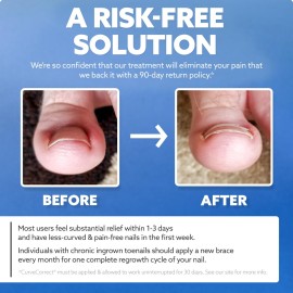 CurveCorrect Ingrown Toenail Corrector Kit - 10 Toenail Braces for Ingrown Toenail Treatment, Pain Relief, and Removal - at Home Big Toe Ingrown Nail Treatment Tool