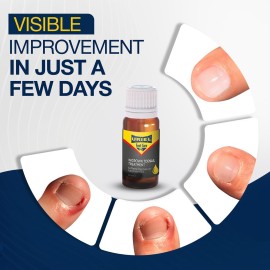 URIEL UPGRADED Ingrown Toenail Treatment, Ingrown Toenail Removal Kit, Ingrown Toenail Corrector, Ingrown Nail Kit Ingrown Toenail Tool 11 ml URIEL UPGRADED Ingrown Toenail Treatment, Ingrown Toenail Removal Kit, Ingrown Toenail Corrector, Ingrown Nail Kit Ingrown Toenail Tool 11 ml