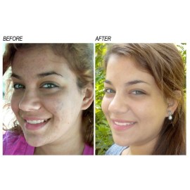 Neoprosone, Vitamin C Serum for Face | 1 Fl oz / 30ml | Brightening Serum For Dark Circle, Wrinkles | with Alpha Arbutin and Castor Oil Neoprosone, Vitamin C Serum for Face | 1 Fl oz / 30ml | Brightening Serum For Dark Circle, Wrinkles | with Alpha Arbutin and Castor Oil