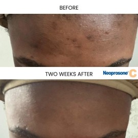 Neoprosone, Vitamin C Serum for Face | 1 Fl oz / 30ml | Brightening Serum For Dark Circle, Wrinkles | with Alpha Arbutin and Castor Oil Neoprosone, Vitamin C Serum for Face | 1 Fl oz / 30ml | Brightening Serum For Dark Circle, Wrinkles | with Alpha Arbutin and Castor Oil