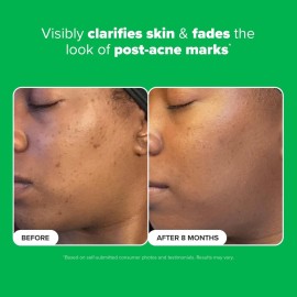 Paula\'s Choice BOOST 10% Azelaic Acid Booster Cream Gel, Licorice Extract & Salicylic Acid, Oil-Free Skin Brightening Serum, 1 Ounce Paula\'s Choice BOOST 10% Azelaic Acid Booster Cream Gel, Licorice Extract & Salicylic Acid, Oil-Free Skin Brightening Serum, 1 Ounce