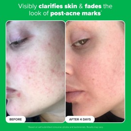 Paula\'s Choice BOOST 10% Azelaic Acid Booster Cream Gel, Licorice Extract & Salicylic Acid, Oil-Free Skin Brightening Serum, 1 Ounce Paula\'s Choice BOOST 10% Azelaic Acid Booster Cream Gel, Licorice Extract & Salicylic Acid, Oil-Free Skin Brightening Serum, 1 Ounce