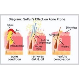 JOESOEF SKIN CARE Sulfur Soap for Acne Pharmaceutical Grade Dermatologists Approved for Acne Rosacea 100G JOESOEF SKIN CARE Sulfur Soap for Acne Pharmaceutical Grade Dermatologists Approved for Acne Rosacea 100G