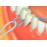 FLOSSAID BridgeAid Threaders 10 Packs of 10 (100 Threaders)