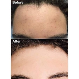 Teenology Shampoo for Teens - Avoid Forehead and Body Breakouts - No Sulfates or Parabens, Noncomedogenic, Natural Botanical Extracts, 16 oz. (Blueberry Pomegranate Cucumber) Teenology Shampoo for Teens - Avoid Forehead and Body Breakouts - No Sulfates or Parabens, Noncomedogenic, Natural Botanical Extracts, 16 oz. (Blueberry Pomegranate Cucumber)