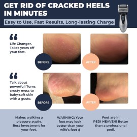 Electric Callus Remover: Rechargeable Electronic Foot File CR900 by Own Harmony(Tested Most Powerful) Best Pedicure Tools w 3 Rollers Professional Pedi Feet Care Sander for Cracked Heels and Hard Skin Electric Callus Remover: Rechargeable Electronic Foot File CR900 by Own Harmony(Tested Most Powerful) Best Pedicure Tools w 3 Rollers Professional Pedi Feet Care Sander for Cracked Heels and Hard Skin