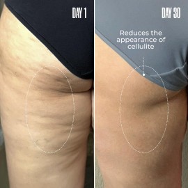 MALYS Cosmetics B-TIGHT Leave-On Cellulite Mask - Reduces The Appearance Of Cellulite - Visibly Tightens The Skin In The Butt Area