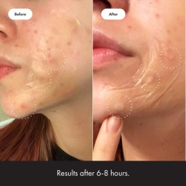 Mighty Patch Surface from Hero Cosmetics - Hydrocolloid Spot Patch for Body, Cheek, Forehead, and Chin, Vegan-friendly (10 Count) Mighty Patch Surface from Hero Cosmetics - Hydrocolloid Spot Patch for Body, Cheek, Forehead, and Chin, Vegan-friendly (10 Count)