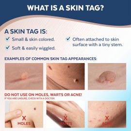 Claritag Advanced Skin Tag Remover - FDA-Cleared Device - Only for Skin Tag Removal - Works in 7-14 Days - Up To 10 Treatment Cycles - Cryogenic Freeze-Off Kit
