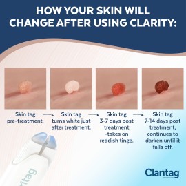 Claritag Advanced Skin Tag Remover - FDA-Cleared Device - Only for Skin Tag Removal - Works in 7-14 Days - Up To 10 Treatment Cycles - Cryogenic Freeze-Off Kit