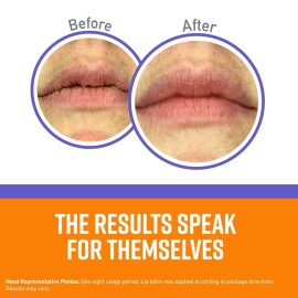 O\'Keeffe\'s Lip Repair Night Treatment Lip Balm for Dry, Cracked Lips - 0.25 Ounce Jar (1 Pack) - Moisturizer Extremely Cracked, Dry Lips O\'Keeffe\'s Lip Repair Night Treatment Lip Balm for Dry, Cracked Lips - 0.25 Ounce Jar (1 Pack) - Moisturizer Extremely Cracked, Dry Lips