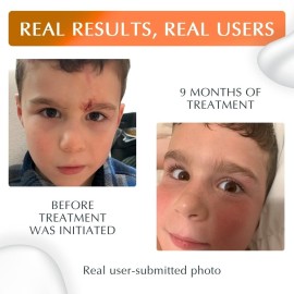 NewGel Plus UV by MyNewGel Advanced Silicone Scar Gel for OLD and NEW Scars with SPF30 Mineral non-chemical Sunscreen, Ideal for Protecting Scars from harmful ultraviolet rays, 15g (0.5 oz)