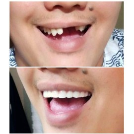 Instant Smile Comfort Fit Flex - Natural Shade - Upper Veneer Cosmetic Teeth Instant Smile Comfort Fit Flex - Natural Shade - Upper Veneer Cosmetic Teeth