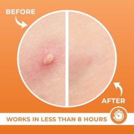 PatchRx Acne Patches (120 Count) with Hydrocolloid Only, Hydrocolloid Pimple Patches for Face - Zit Patch Acne Dots - Acne Patches - Pimple Patch with 3 Size Acne Stickers