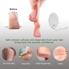 Natural Foot Pumice Stone for Feet, Borogo 2-Pack Lava Pedicure Tools Hard Skin Callus Remover for Feet and Hands - White&Red Natural Foot Pumice Stone for Feet, Borogo 2-Pack Lava Pedicure Tools Hard Skin Callus Remover for Feet and Hands - White&Red