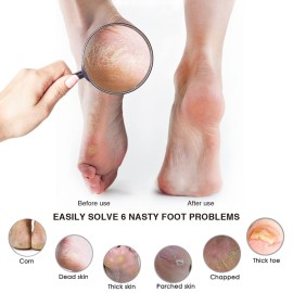 Pumice Stone Foot File (2-Pack), Wooden Handle Foot Scrubber & Callus Remover for Dry, Rough Skin and Corns Pedicure Pumice Stone Foot File (2-Pack), Wooden Handle Foot Scrubber & Callus Remover for Dry, Rough Skin and Corns Pedicure