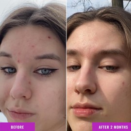 Good Molecules Niacinamide Serum - 10% Niacinamide Balancing B3 Facial Serum for Acne, Tone, Texture - Brightening and Hydrating Skincare for Face Good Molecules Niacinamide Serum - 10% Niacinamide Balancing B3 Facial Serum for Acne, Tone, Texture - Brightening and Hydrating Skincare for Face