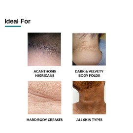 FIXDERMA Nigrifix Cream for Acanthosis Nigricans with Lactic Acid | Dermatologist Tested Retinol Cream | Useful for Dark Body Parts like Neck, Ankles, Armpits & Elbows -3.52 FlOz FIXDERMA Nigrifix Cream for Acanthosis Nigricans with Lactic Acid | Dermatologist Tested Retinol Cream | Useful for Dark Body Parts like Neck, Ankles, Armpits & Elbows -3.52 FlOz