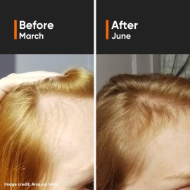 Minimalist Hair Density Serum 18% | With Procapil, Capixyl, Redensyl, Anagain & Baicapil For Hair Fall Control | Women & Men | 30 ml Minimalist Hair Density Serum 18% | With Procapil, Capixyl, Redensyl, Anagain & Baicapil For Hair Fall Control | Women & Men | 30 ml