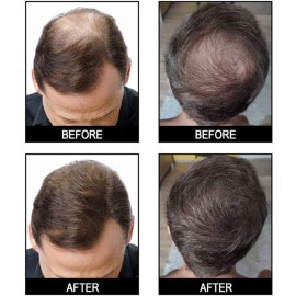 GOWWIM Hair Thickening Fibers 2-in-1 Kit Keratin Building Fibers, Spray Applicator & Hold Spray - Instantly Volumize Sparse Areas (Black)