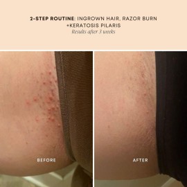 Bushbalm Ingrown Hair Oil - Helps With Ingrown Hair, Underarm Bumps, Soothes Razor Bumps, Post Shave Redness and Itching - 30ml Sweet Escape Bushbalm Ingrown Hair Oil - Helps With Ingrown Hair, Underarm Bumps, Soothes Razor Bumps, Post Shave Redness and Itching - 30ml Sweet Escape