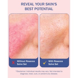 Rosacea Solve Skincare Set for Women & Men - Gentle Face Wash, Rosacea Cream & Face Serum for Skin Redness - Day & Night Hydrating Facial Cleanser & Sensitive Skin Moisturizer by e70 Rosacea Solve Skincare Set for Women & Men - Gentle Face Wash, Rosacea Cream & Face Serum for Skin Redness - Day & Night Hydrating Facial Cleanser & Sensitive Skin Moisturizer by e70