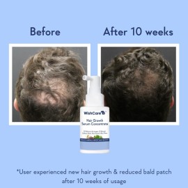 WishCare Hair Growth Serum Concentrate - Rosemary, 3% Redensyl, 4% Anagain, 2% Baicapil, Caffeine, Biotin, Plant Keratin & Rice Water WishCare Hair Growth Serum Concentrate - Rosemary, 3% Redensyl, 4% Anagain, 2% Baicapil, Caffeine, Biotin, Plant Keratin & Rice Water