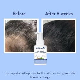 WishCare Hair Growth Serum Concentrate - Rosemary, 3% Redensyl, 4% Anagain, 2% Baicapil, Caffeine, Biotin, Plant Keratin & Rice Water WishCare Hair Growth Serum Concentrate - Rosemary, 3% Redensyl, 4% Anagain, 2% Baicapil, Caffeine, Biotin, Plant Keratin & Rice Water