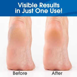 DeEnti Callus Remover for Feet, Extra Strength Foot Callus Remover Gel, 8oz Salon Grade Home Pedicure Supplies for Dry Skin, Cracked Heel, Professional Strength Foot Care, Unscented DeEnti Callus Remover for Feet, Extra Strength Foot Callus Remover Gel, 8oz Salon Grade Home Pedicure Supplies for Dry Skin, Cracked Heel, Professional Strength Foot Care, Unscented