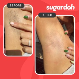 Sugardoh Sugar Waxing Kit for Women As Seen On Shark Tank (Mini Kit Firm) Face, Arms, & Legs, Sugar Wax Hair Removal- Sugaring Tiktok Viral Products- Bikini Wax Kit for Women - Sugaring Kit Sugardoh Sugar Waxing Kit for Women As Seen On Shark Tank (Mini Kit Firm) Face, Arms, & Legs, Sugar Wax Hair Removal- Sugaring Tiktok Viral Products- Bikini Wax Kit for Women - Sugaring Kit