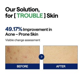 MEDIHEAL Teatree Trouble Facial Toner Pads with Tea Tree & Lactobacillus - Calming & Soothing for Sensitive & Acne Prone Skin - Vegan Face Gauze, 100 Pads MEDIHEAL Teatree Trouble Facial Toner Pads with Tea Tree & Lactobacillus - Calming & Soothing for Sensitive & Acne Prone Skin - Vegan Face Gauze, 100 Pads