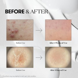 VT COSMETICS CICA Reedle Shot 100, Spicule Microneedling Serum for Pore Care & Exfoliation, Exosome, Centella Asiatica for Glass Skin, Skin Texture, Korean Liquid Skin Booster (1.69 Fl Oz / 50ml) VT COSMETICS CICA Reedle Shot 100, Spicule Microneedling Serum for Pore Care & Exfoliation, Exosome, Centella Asiatica for Glass Skin, Skin Texture, Korean Liquid Skin Booster (1.69 Fl Oz / 50ml)