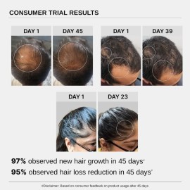 Bare Anatomy Advanced Hair Growth Serum| 3% Redensyl - 2x Better Results than Minoxidil | + 4% Anagain + 3% Baicapil | Rosemary, Biotin | Hair growth & Hair fall control serum for Women & Men | 30mL Bare Anatomy Advanced Hair Growth Serum| 3% Redensyl - 2x Better Results than Minoxidil | + 4% Anagain + 3% Baicapil | Rosemary, Biotin | Hair growth & Hair fall control serum for Women & Men | 30mL
