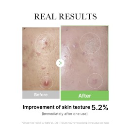 Medicube Exosome Cica Tea Tree Ampoule for Sensitive Skin with Centella Asiatica help reduce redness and breakouts. Low-irritating, Moisturizing & Soothing Serum | Korean Skincare | 30ml