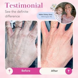 Theraplex Clear Emollient Lotion (8 oz) - No Parabens or Preservatives, Noncomedogenic and Hypoallergenic, Fragrance Free, Dermatologist recommended - National Eczema Association Seal of Acceptance Theraplex Clear Emollient Lotion (8 oz) - No Parabens or Preservatives, Noncomedogenic and Hypoallergenic, Fragrance Free, Dermatologist recommended - National Eczema Association Seal of Acceptance