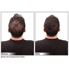 Hair Building Fibers Instantly Conceal Thinning Hair and Bald Spots for Men & Women (Large 28 Grams Bottle) - Undetectable, Washes Away, For All Hair Types, No Animal Byproducts (Medium Brown)