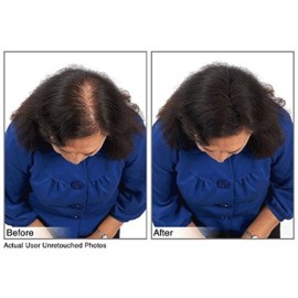 Hair Building Fibers Instantly Conceal Thinning Hair and Bald Spots for Men & Women (Large 28 Grams Bottle) - Undetectable, Washes Away, For All Hair Types, No Animal Byproducts (Medium Brown)