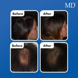 MD Factor Natural Hair Growth Serum | Follicle Energizer Serum - Prevents Thinning Hair & Hair Loss By Stimulating Hair Follicles To Produce Thicker, Fuller Hair (30-Day Supply Per Tube)