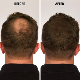 ECLIPSE Hair Fibers Dark Brown for Thinning Hair for Women & Men to Conceal Hair Loss in 15 Seconds - 100% Undetectable Hair Building Fibers, 30g ECLIPSE Hair Fibers Dark Brown for Thinning Hair for Women & Men to Conceal Hair Loss in 15 Seconds - 100% Undetectable Hair Building Fibers, 30g