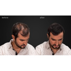 LUXE Hair Thickening Fibers - CONFIDENCE IN A JAR - 2 Months+ Supply! - Hypoallergenic, Dermatologist Tested - Multiple Colors Available (Medium Brown) LUXE Hair Thickening Fibers - CONFIDENCE IN A JAR - 2 Months+ Supply! - Hypoallergenic, Dermatologist Tested - Multiple Colors Available (Medium Brown)