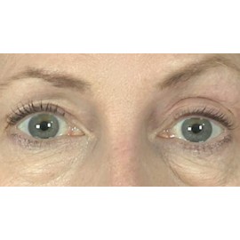 Butterfly Invisible Double Eye Lift Butterfly Invisible Double Eye Lift