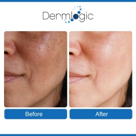 Anti Aging Resurfacing Peel Pads- Triple Action Chemical Peel Pads Combined with Glycolic, Lactic, and Salicylic Acids. Smooths Fine Lines, Wrinkles, Dark Spots, and Imperfections to Enhance the Skin