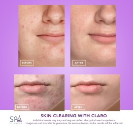 Spa Sciences CLARO Clinically Proven Blue & Red LED Acne Treatment Light Therapy System-FDA Cleared-Rechargeable- Professional Home Acne Healing/Clearing Treatment Spa Sciences CLARO Clinically Proven Blue & Red LED Acne Treatment Light Therapy System-FDA Cleared-Rechargeable- Professional Home Acne Healing/Clearing Treatment
