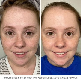 Bioelements. Quick Refiner for Eyes - 0.5 fl oz - Wrinkle-Reducing, Gentle AHA & Lactic Acid Peel for Eyes - All Skin Types - Vegan, Gluten Free - Never Tested on Animals Bioelements. Quick Refiner for Eyes - 0.5 fl oz - Wrinkle-Reducing, Gentle AHA & Lactic Acid Peel for Eyes - All Skin Types - Vegan, Gluten Free - Never Tested on Animals