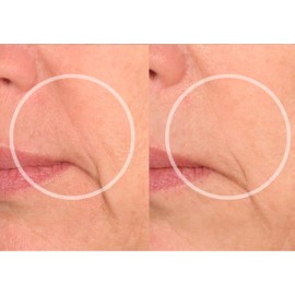 SiO Beauty Eye & Smile Lift - Eye & Smile Anti-Wrinkle Patches 2 Week Supply - Overnight Smoothing Silicone Patches for Wrinkles and Fine Lines