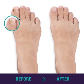 Trim Simply Foot Ingrown Toenail Kit - Includes Stainless Steel Toenail Nipper and Stainless Steel Dual-Ended File - Professional Foot Care Set for Salon Quality Grooming - Easy-to-Use - 2 Piece Set