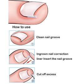 (50 +2) Pack Professional Ingrown Toenail Correction Treatment Kit, 50 Pcs Ingrown Toenail Corrector Straightener Strips Recover Clips with 2 Pcs Ingrown Toenail File And Lifter