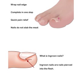 (50 +2) Pack Professional Ingrown Toenail Correction Treatment Kit, 50 Pcs Ingrown Toenail Corrector Straightener Strips Recover Clips with 2 Pcs Ingrown Toenail File And Lifter